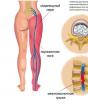 Причины защемления нерва в пояснице и почему боль отдает в ногу: симптомы и лечение недуга