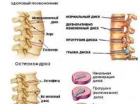 Exercise therapy for osteochondrosis of the cervical spine: recommendations for exercises, contraindications for implementation