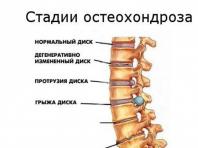 Neck cushion for osteochondrosis: benefits and effectiveness