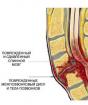 Poškodenie chrbtice a miechy Poškodenie miechy v driekovej oblasti