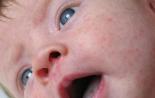 Alergie u dojčiat: príznaky a liečba Potravinové alergie u dojčiat