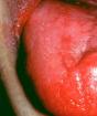 Addison-Birmer disease - symptoms, treatment