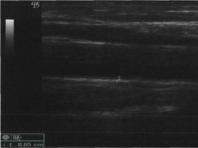 Ультразвуковое сканирование магистральных артерий нижних конечностей
